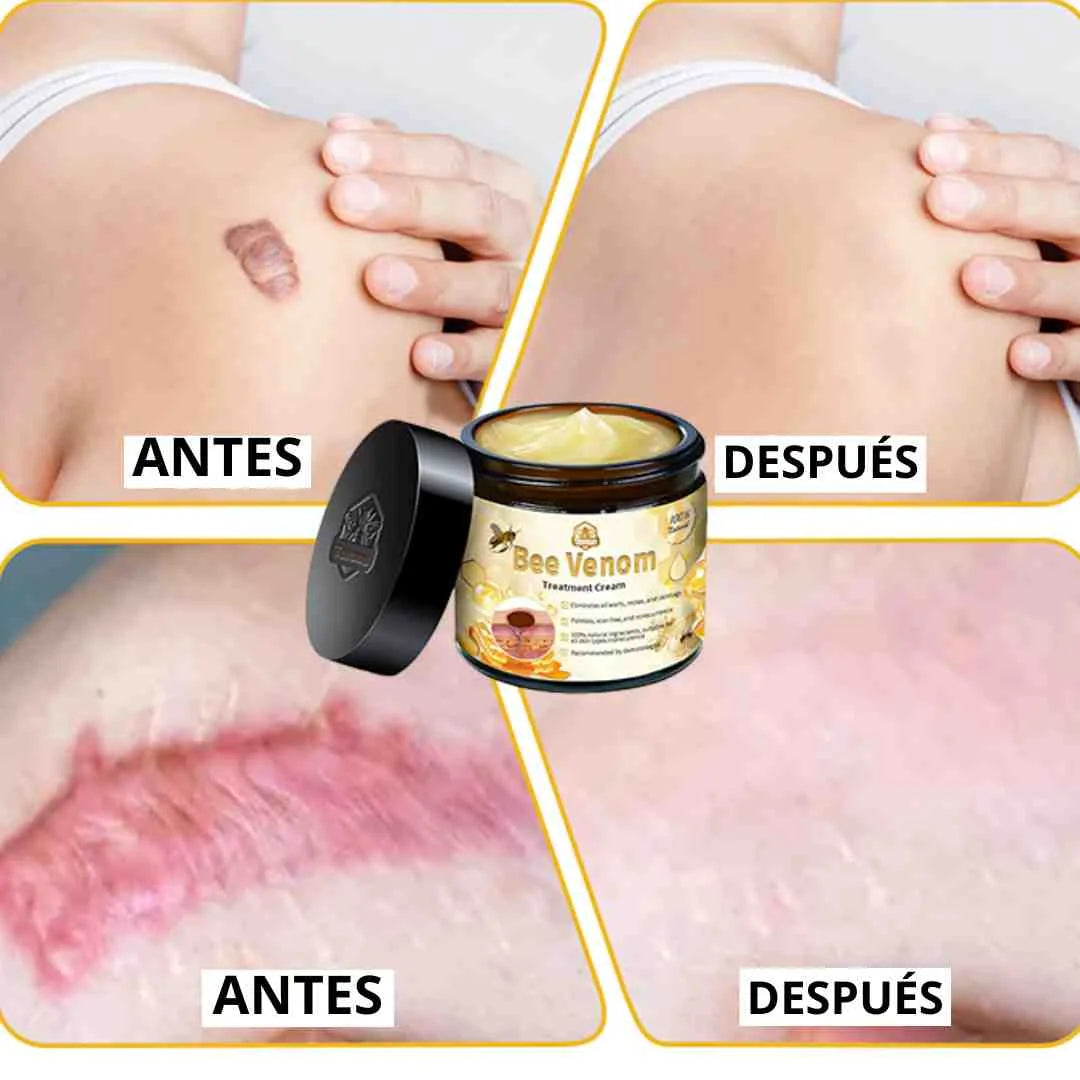 crema abeja quita manchas y verrugas en promocion