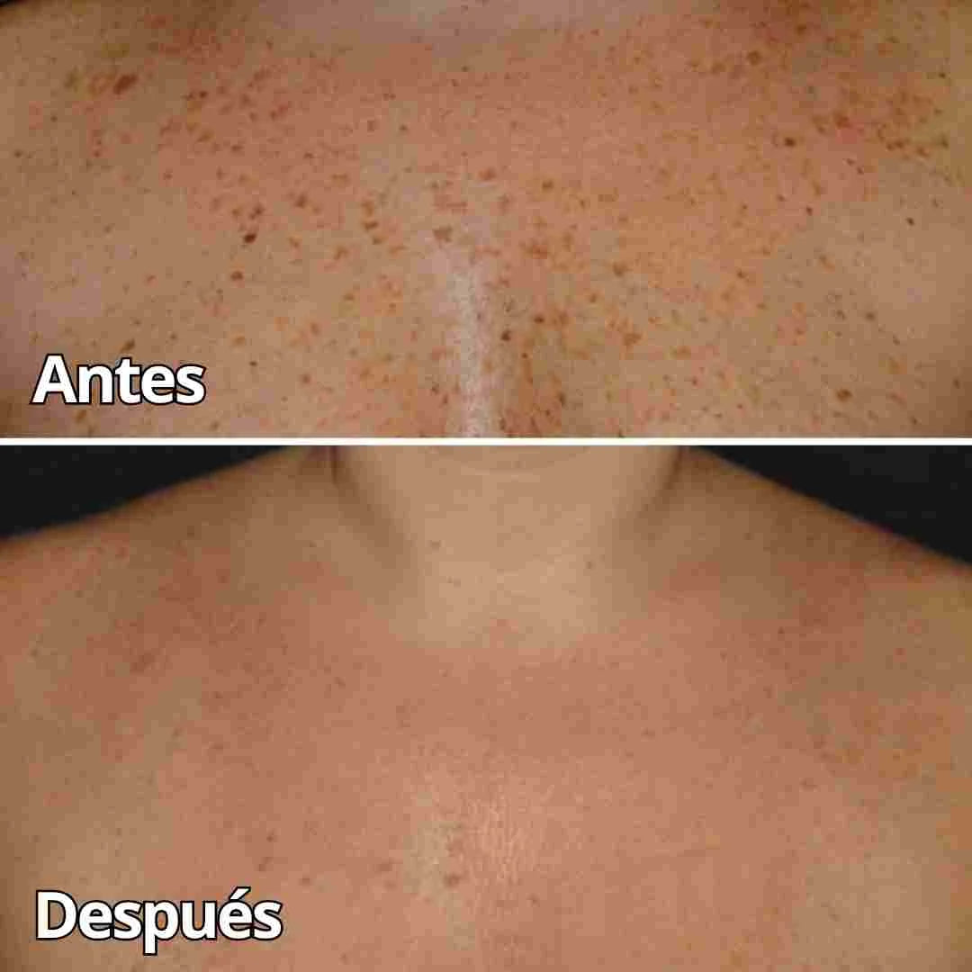 crema abeja quita manchas y verrugas en promocion