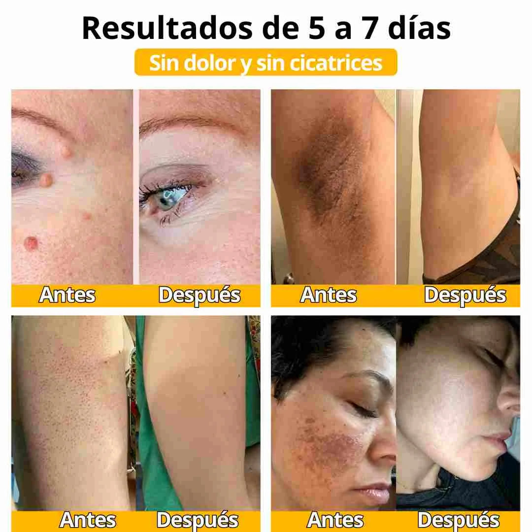 crema abeja quita manchas y verrugas en promocion