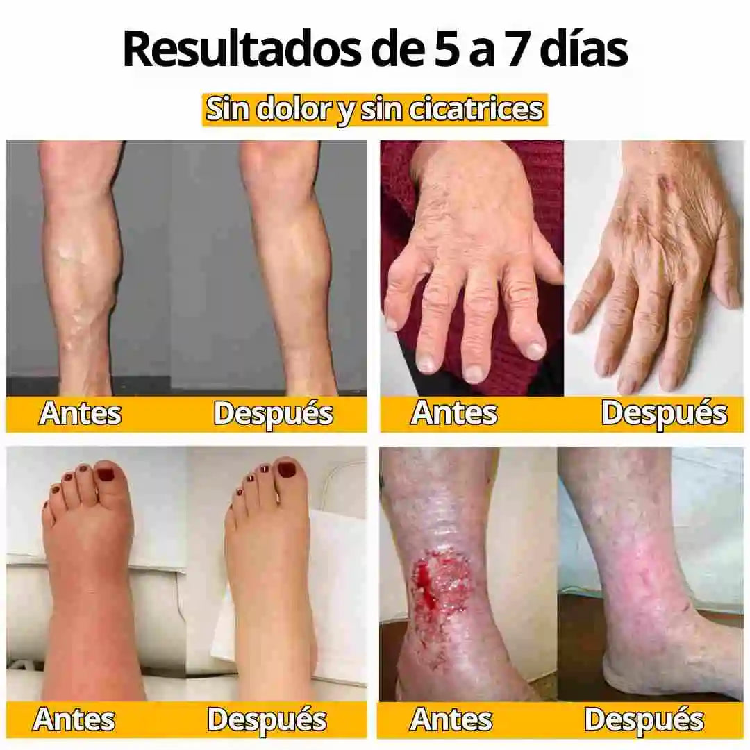 crema abeja quita manchas y verrugas en promocion