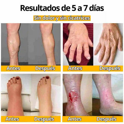 crema abeja quita manchas y verrugas en promocion